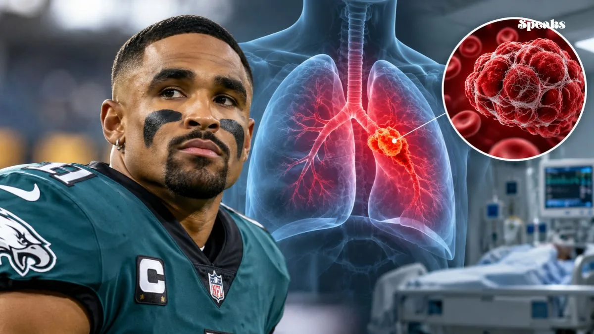 Blood Clots in Lungs: What Jalen Hurts’ Diagnosis Reveals About Pulmonary Embolism Risks